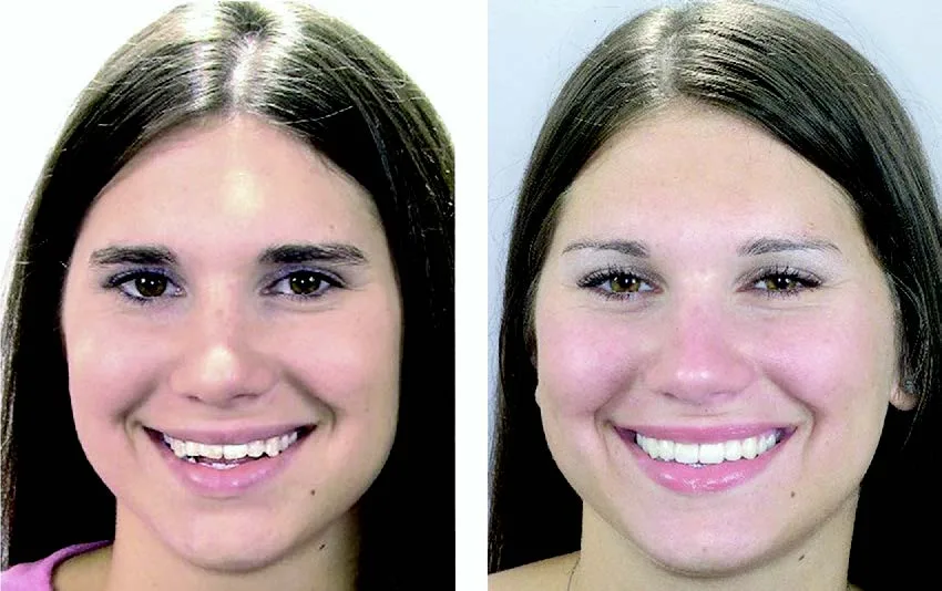 Early Orthodontic Treatment